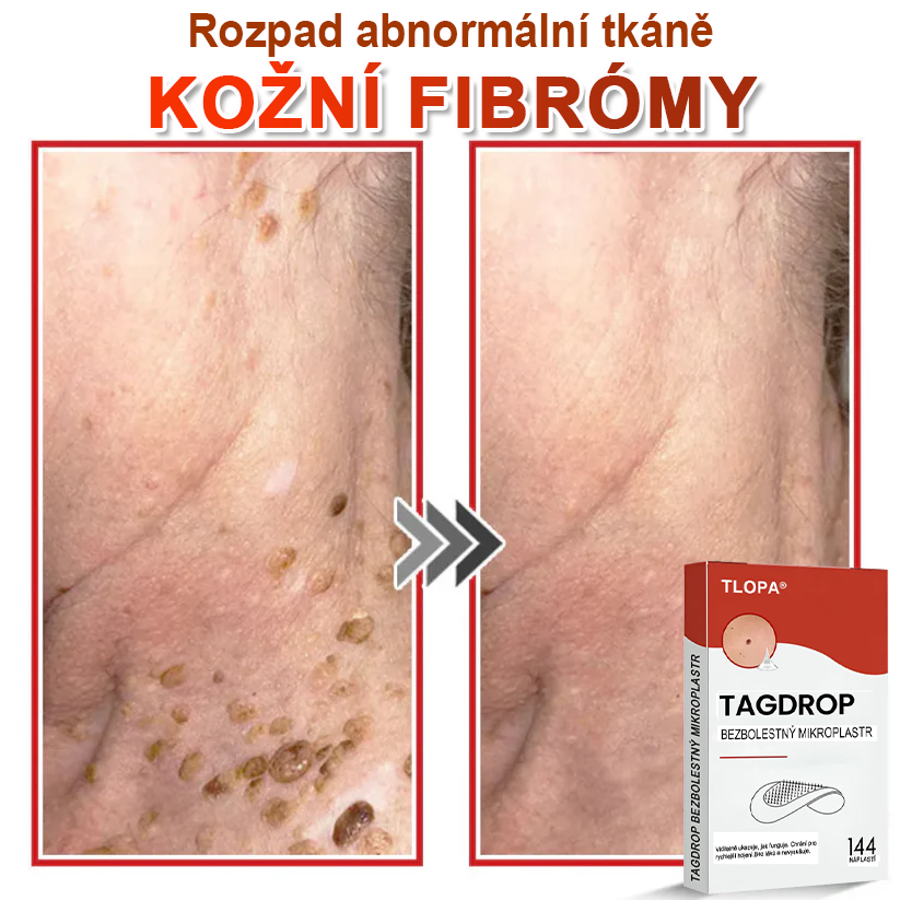TLOPA® Mikrovpichová botanická náplast na odstranění kožních výrůstků 🇨🇿 Vyrobeno v Česká republika🇨🇿🇨🇿