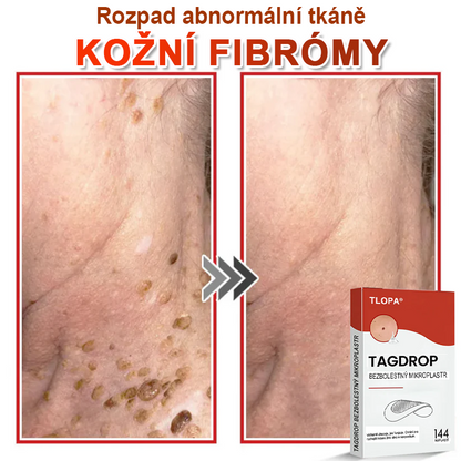 TLOPA® Mikrovpichová botanická náplast na odstranění kožních výrůstků 🇨🇿 Vyrobeno v Česká republika🇨🇿🇨🇿