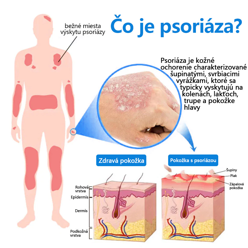 Oficiálny obchod✨: Zvoevo®Horčíkový bylinný sprej na psoriázu⚕️certifikované FDA (úľava od psoriázy a ekzému, zlepšenie bakteriálnych infekcií v oblasti genitálií a liečba akné a tmavých škvŕn)