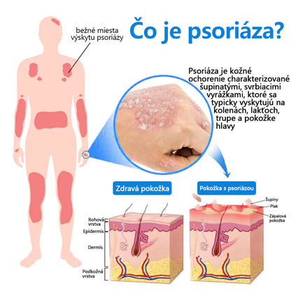 Oficiálny obchod✨: Zvoevo®Horčíkový bylinný sprej na psoriázu⚕️certifikované FDA (úľava od psoriázy a ekzému, zlepšenie bakteriálnych infekcií v oblasti genitálií a liečba akné a tmavých škvŕn)