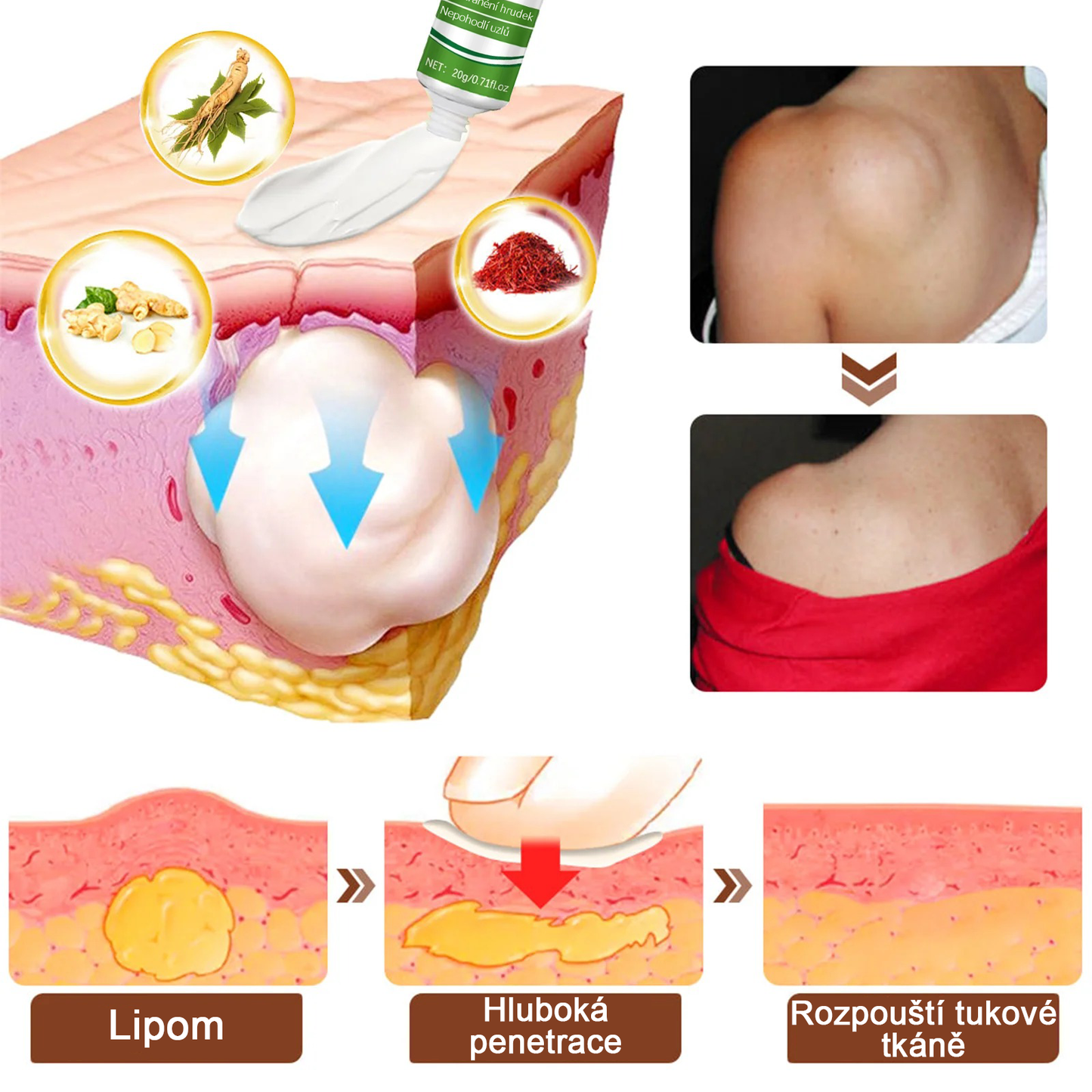Cvreoz® LipomaCure — Účinná péče o lipomy bez operace