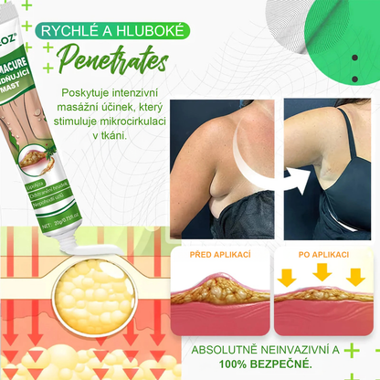 Cvreoz® LipomaCure — Účinná péče o lipomy bez operace