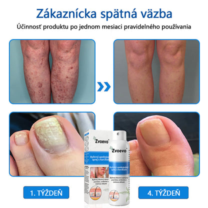 Oficiálny obchod✨: Zvoevo®Horčíkový bylinný sprej na psoriázu⚕️certifikované FDA (úľava od psoriázy a ekzému, zlepšenie bakteriálnych infekcií v oblasti genitálií a liečba akné a tmavých škvŕn)