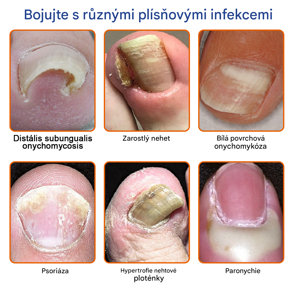 🐝🐝FurzeroTM Řešení pro léčbu nehtové plísně včelím jedem: Kompletní řešení nehtové plísně🌟👣👣