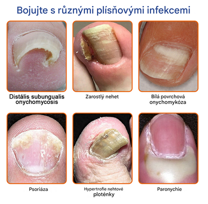 🐝🐝FurzeroTM Řešení pro léčbu nehtové plísně včelím jedem: Kompletní řešení nehtové plísně🌟👣👣