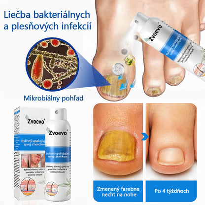 Oficiálny obchod✨: Zvoevo®Horčíkový bylinný sprej na psoriázu⚕️certifikované FDA (úľava od psoriázy a ekzému, zlepšenie bakteriálnych infekcií v oblasti genitálií a liečba akné a tmavých škvŕn)