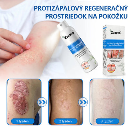 Oficiálny obchod✨: Zvoevo®Horčíkový bylinný sprej na psoriázu⚕️certifikované FDA (úľava od psoriázy a ekzému, zlepšenie bakteriálnych infekcií v oblasti genitálií a liečba akné a tmavých škvŕn)