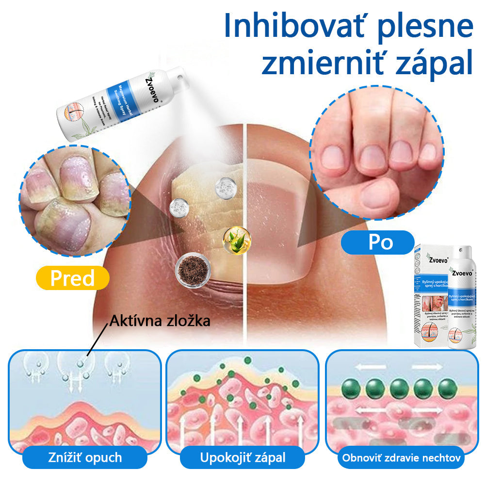 Oficiálny obchod✨: Zvoevo®Horčíkový bylinný sprej na psoriázu⚕️certifikované FDA (úľava od psoriázy a ekzému, zlepšenie bakteriálnych infekcií v oblasti genitálií a liečba akné a tmavých škvŕn)